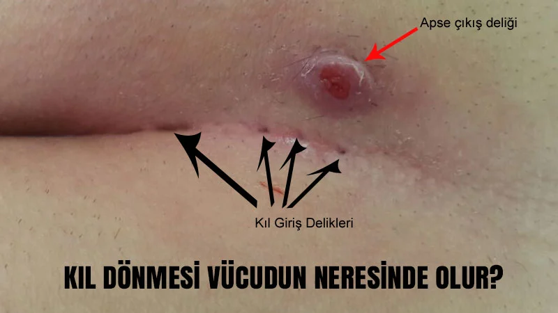 Kıl dönmesi vücudun neresinde olur